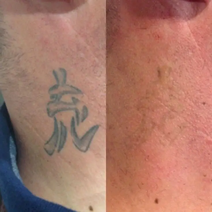 Tattoo Removal & Cover-up example — Trendy Tattoo & Piercing Studio, Vijayawada