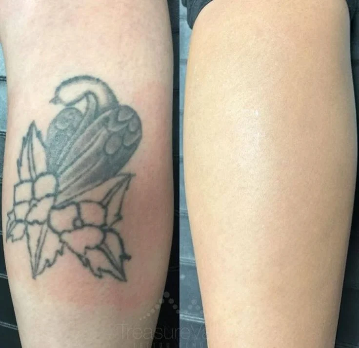 Tattoo Removal & Cover-up example — Trendy Tattoo & Piercing Studio, Vijayawada