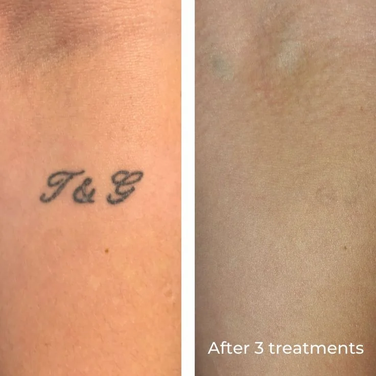 Tattoo Removal & Cover-up example — Trendy Tattoo & Piercing Studio, Vijayawada