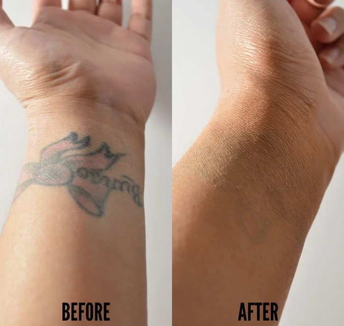 Tattoo Removal & Cover-up example — Trendy Tattoo & Piercing Studio, Vijayawada