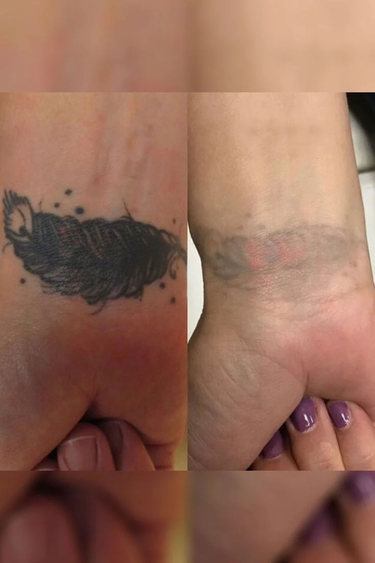 Tattoo Removal & Cover-up example — Trendy Tattoo & Piercing Studio, Vijayawada