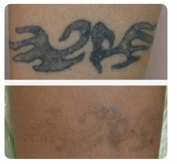 Tattoo Removal & Cover-up example — Trendy Tattoo & Piercing Studio, Vijayawada