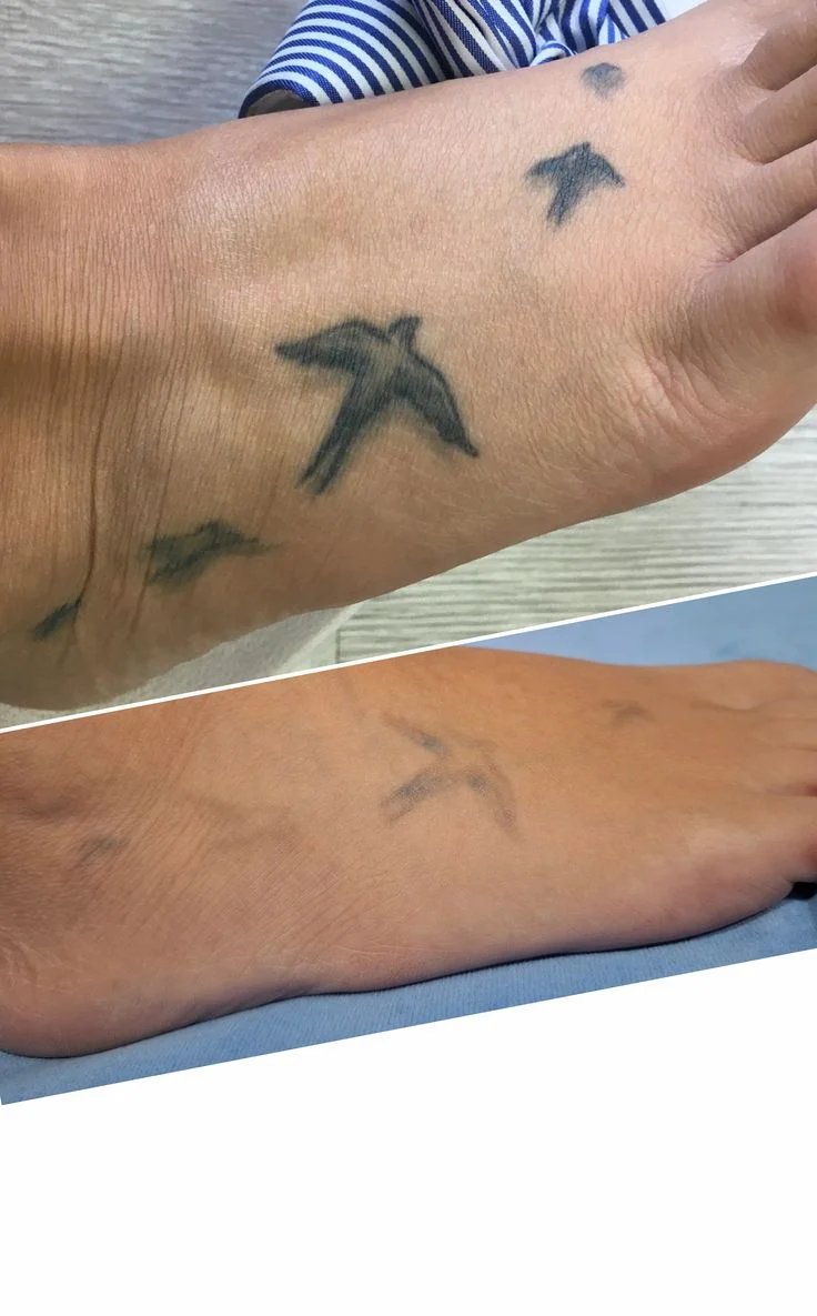 Tattoo Removal & Cover-up example — Trendy Tattoo & Piercing Studio, Vijayawada